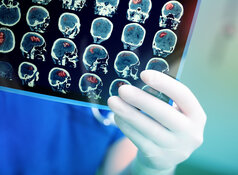 Pharma to Test if DMT Helps Brain Regain Function Post Stroke