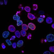 Myelofibrosis Combo Advances as Karyopharm Preps August sNDA